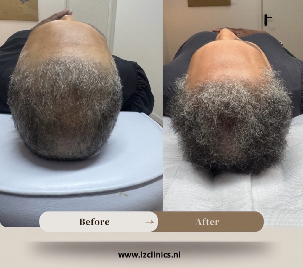 Voor en na haarbehandeling bij LZ Clinics Amsterdam