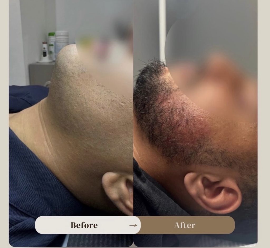 Voor en na baardbehandeling bij LZ Clinics Amsterdam