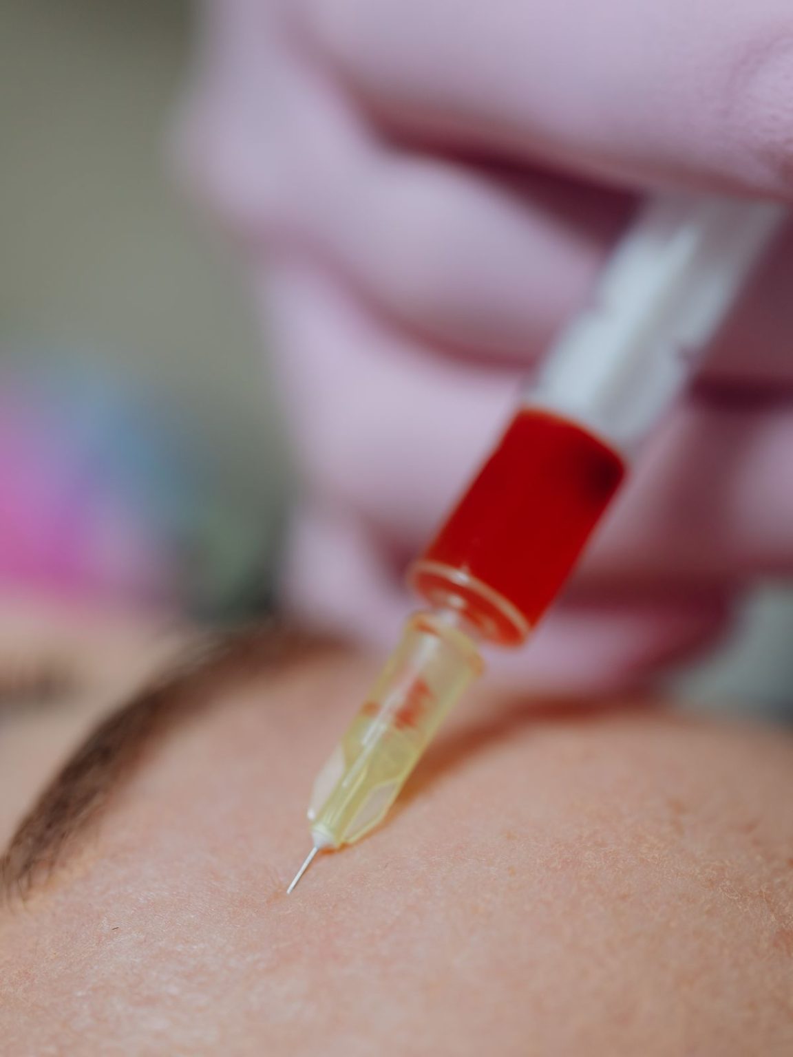 Vampire facial met PRP uit eigen bloed bij LZ Clinics Amsterdam