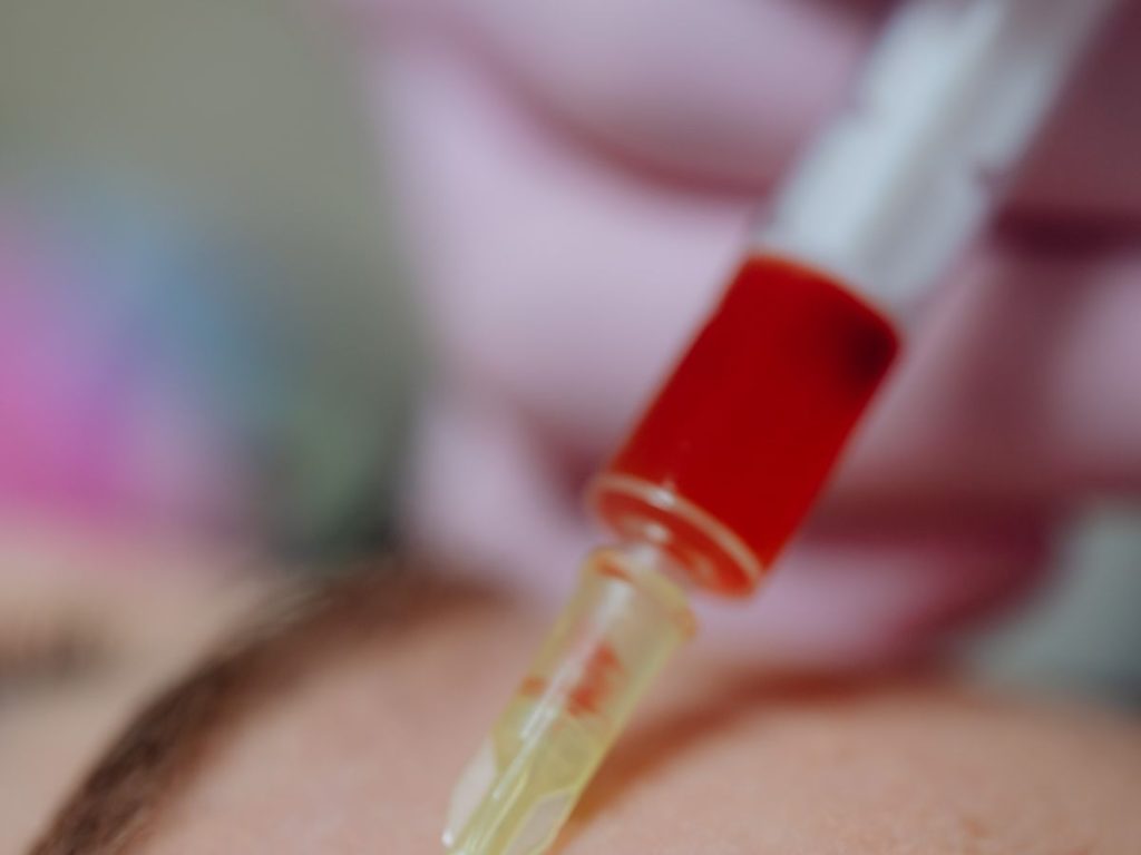 Vampire facial met PRP uit eigen bloed bij LZ Clinics Amsterdam